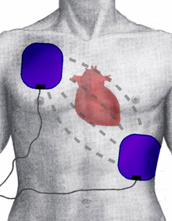 Defibrillation Are You Making These Deadly Mistakes - x3rd6yt