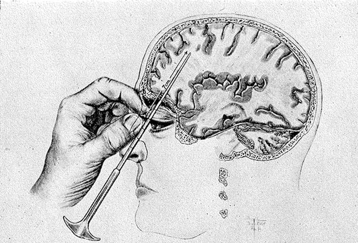 Lobotomy | Wiki | Everipedia