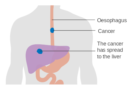 cancer esophageal wiki everipedia