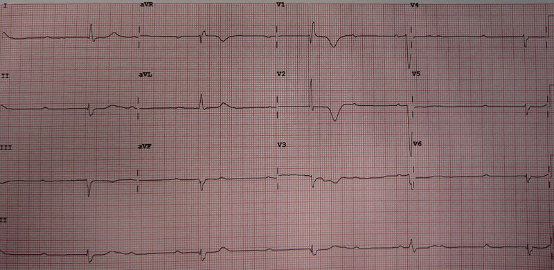 Third degree Atrioventricular Block Wiki Everipedia